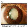       (Cataract)
